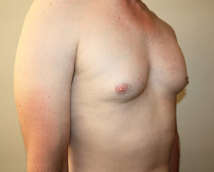 Gynecomastia Before & After Patient #2461
