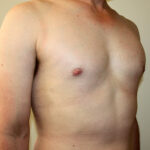 Gynecomastia Before & After Patient #2461