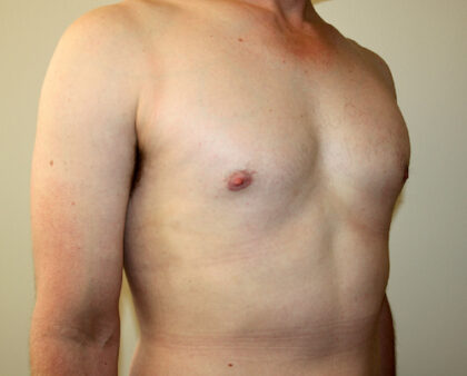 Gynecomastia Before & After Patient #2461