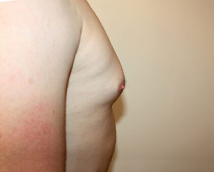 Gynecomastia Before & After Patient #2461