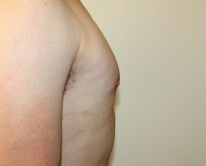 Gynecomastia Before & After Patient #2461