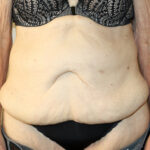 Tummy Tuck Before & After Patient #2555
