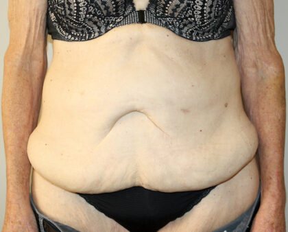 Tummy Tuck Before & After Patient #2555