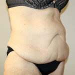 Tummy Tuck Before & After Patient #2555
