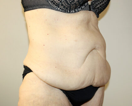 Tummy Tuck Before & After Patient #2555