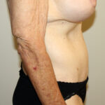 Tummy Tuck Before & After Patient #2555