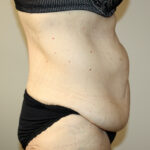 Tummy Tuck Before & After Patient #2555