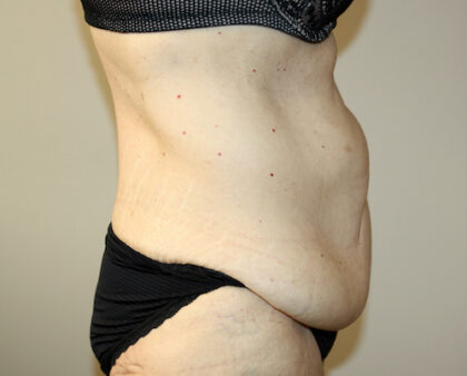 Tummy Tuck Before & After Patient #2555