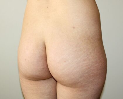 Brazilian Butt Lift Before & After Patient #2292