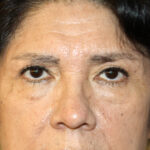 Blepharoplasty Before & After Patient #2426