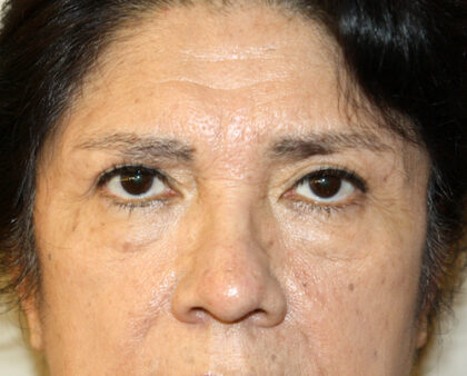 Blepharoplasty Before & After Patient #2426