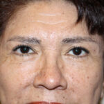 Blepharoplasty Before & After Patient #2426