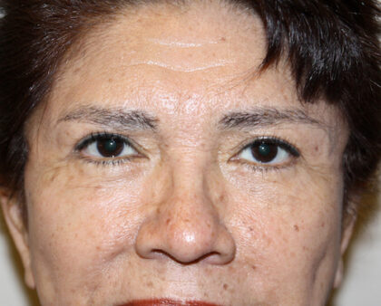 Blepharoplasty Before & After Patient #2426