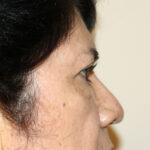 Blepharoplasty Before & After Patient #2426