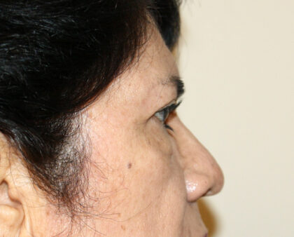 Blepharoplasty Before & After Patient #2426