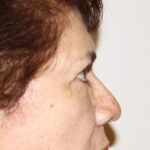 Blepharoplasty Before & After Patient #2426