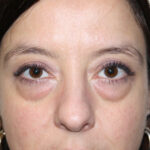 Blepharoplasty Before & After Patient #2433