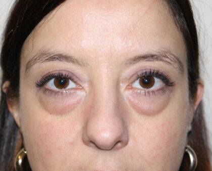 Blepharoplasty Before & After Patient #2433