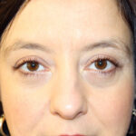 Blepharoplasty Before & After Patient #2433