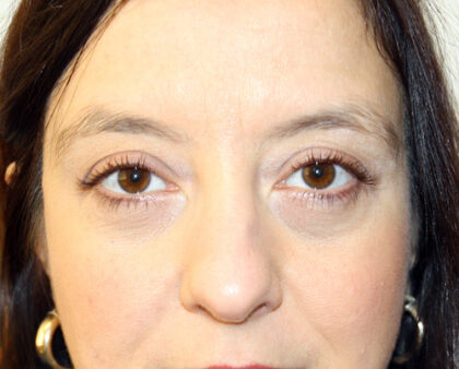 Blepharoplasty Before & After Patient #2433