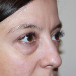 Blepharoplasty Before & After Patient #2433