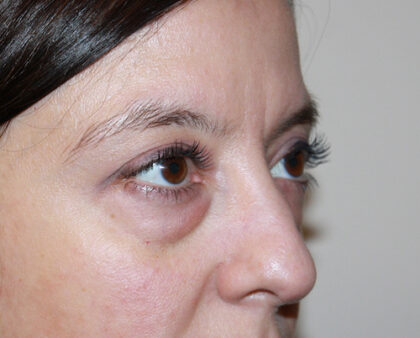 Blepharoplasty Before & After Patient #2433