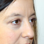 Blepharoplasty Before & After Patient #2433