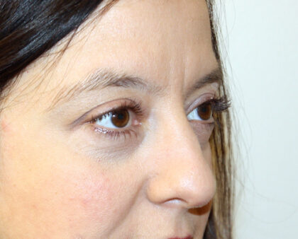 Blepharoplasty Before & After Patient #2433