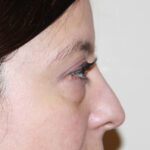 Blepharoplasty Before & After Patient #2433