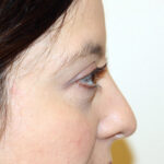 Blepharoplasty Before & After Patient #2433