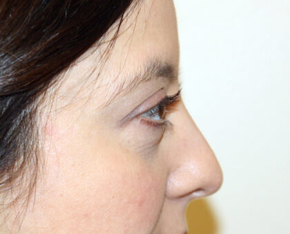 Blepharoplasty Before & After Patient #2433