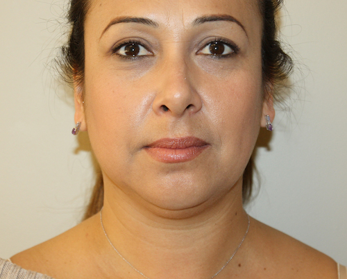 Neck Liposuction Before & After Patient #2506