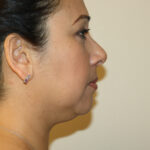 Neck Liposuction Before & After Patient #2506