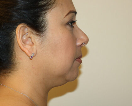 Neck Liposuction Before & After Patient #2506