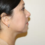 Neck Liposuction Before & After Patient #2506