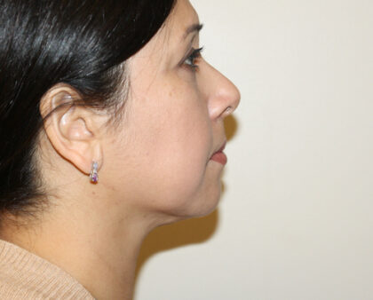 Neck Liposuction Before & After Patient #2506
