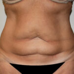 Tummy Tuck Before & After Patient #2569