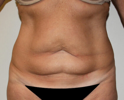 Tummy Tuck Before & After Patient #2569