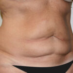 Tummy Tuck Before & After Patient #2569