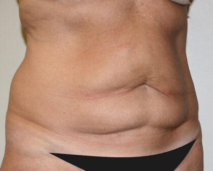 Tummy Tuck Before & After Patient #2569