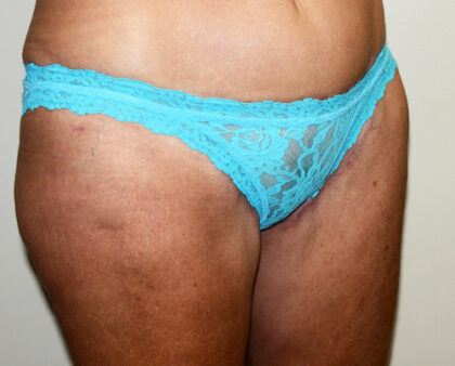 Thigh Lift Before & After Patient #2526