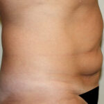 Tummy Tuck Before & After Patient #2569