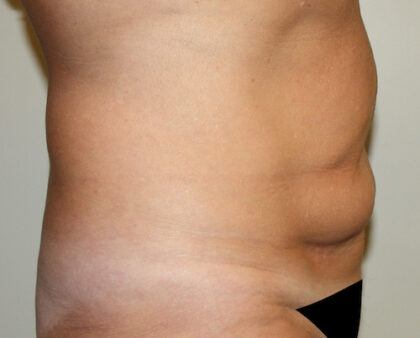 Tummy Tuck Before & After Patient #2569