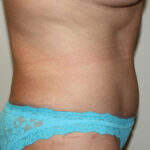 Tummy Tuck Before & After Patient #2569