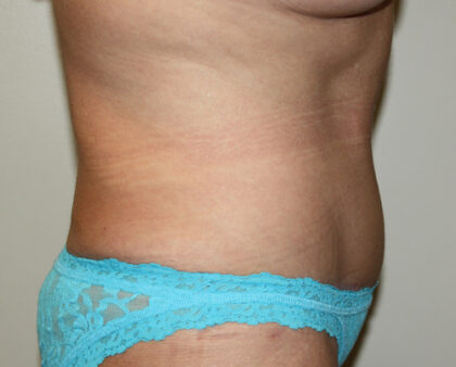 Tummy Tuck Before & After Patient #2569