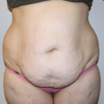 Tummy Tuck Before & After Patient #2583