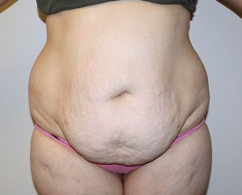 Tummy Tuck Before & After Patient #2583