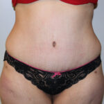 Tummy Tuck Before & After Patient #2583