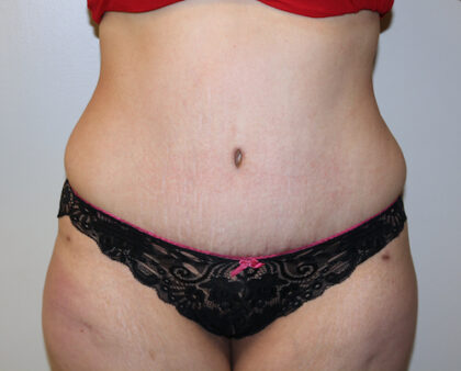 Tummy Tuck Before & After Patient #2583