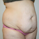 Tummy Tuck Before & After Patient #2583